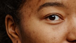 3 Best Dark Spot Correctors for Acne Scars, Melasma, and More
