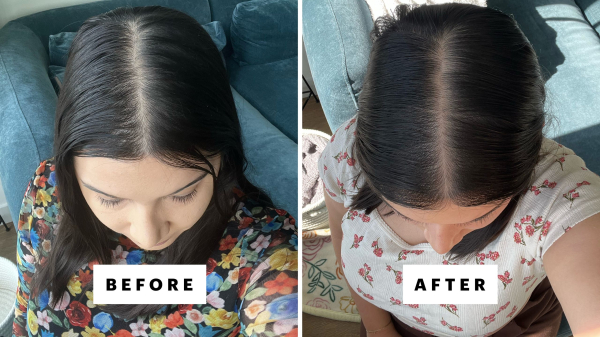 I Used PRP to Treat My Hair Loss